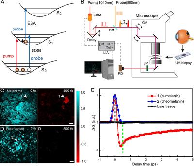 Label-Free Delineation of Human Uveal Melanoma Infiltration With Pump–Probe Microscopy